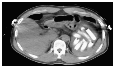 CT scan met bolletjes in de maag en het colon